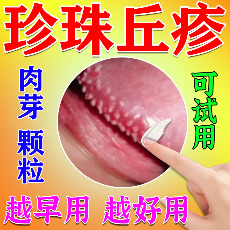 龟头炎】症冠状沟珍珠状疹去除膏