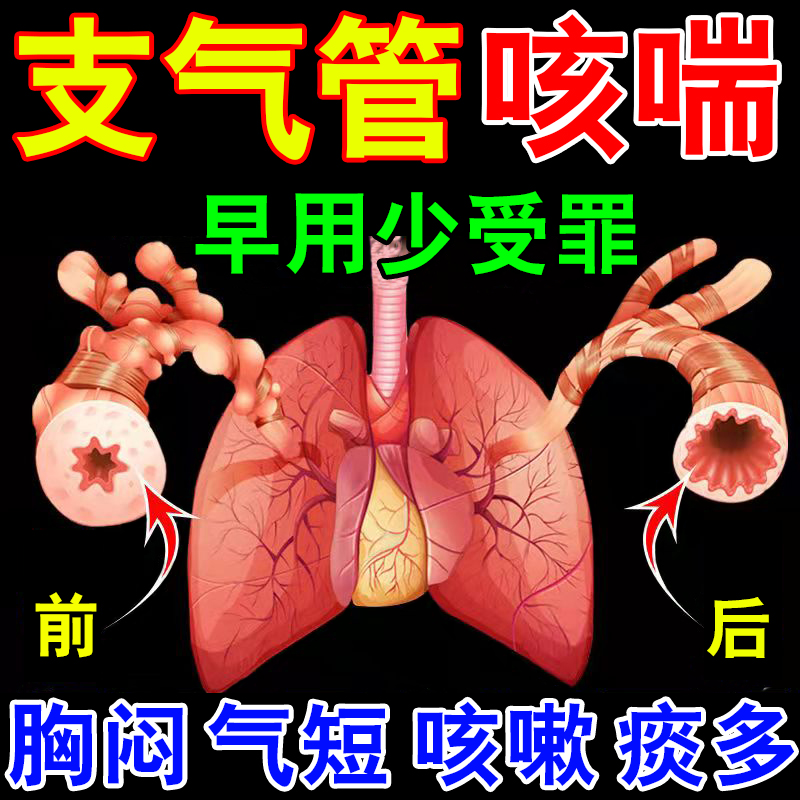支气管炎止咳清肺化痰贴咳嗽药胸闷气短急慢性支气管咳喘中药贴Z