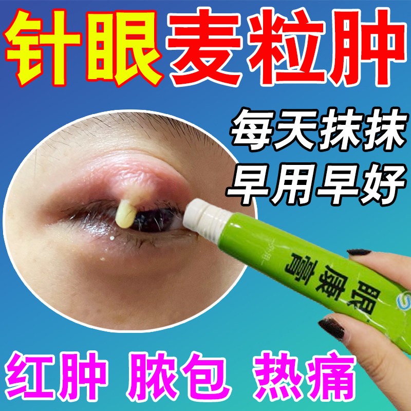 麦粒肿眼贴药膏霰粒肿脸板腺炎囊肿热敷眼皮红肿痒针眼疏通神器Z