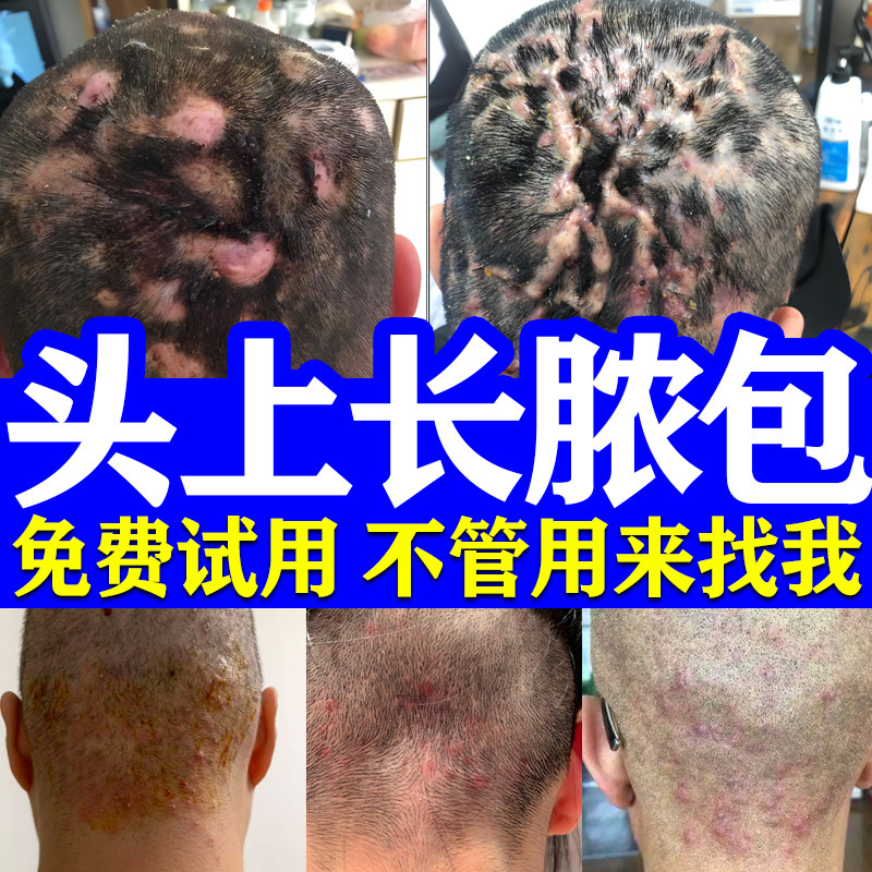 免费试用】去毛囊炎用专药膏
