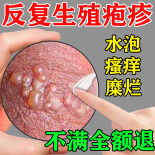 生殖器疱疹断治hsv药男女下体根私处喷剂瘙痒疼痛性病梅毒外用膏
