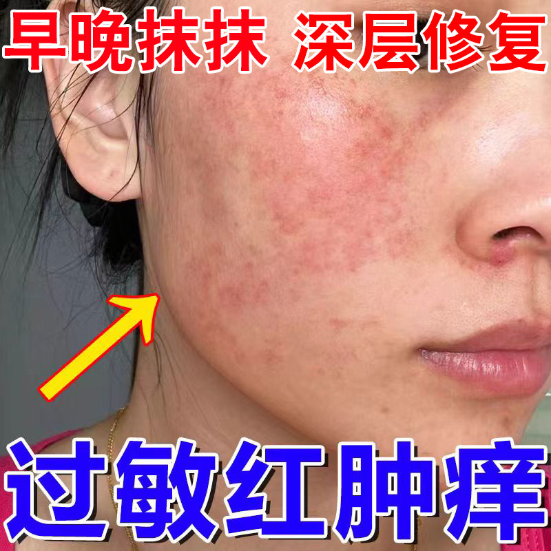 过敏皮肤修复脸部医用痒红肿干燥起皮脸上泛红血丝敏感肌晒伤痒Z