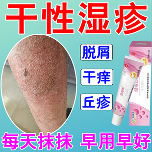 干性湿疹膏无激素宝宝特应性皮炎止痒去冬天皮肤干燥痒根保湿霜Z