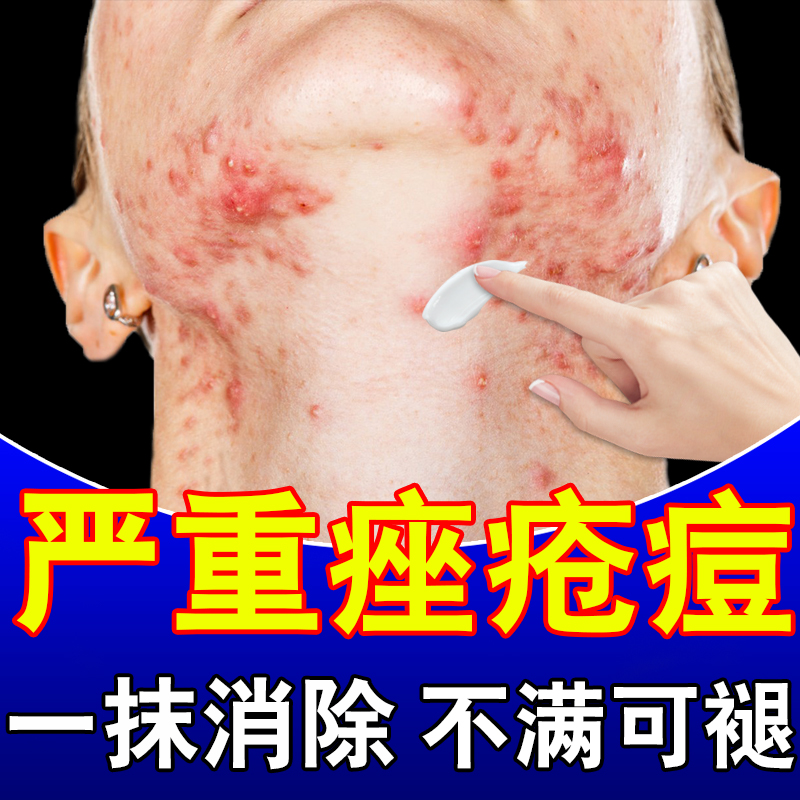 痤疮膏祛痘重度暗疮药膏淋巴痘腮边痘下巴长痘印结节硬块修复Z