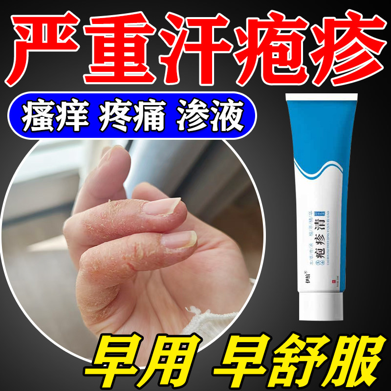 汗泡疱疹止痒去用根专药膏
