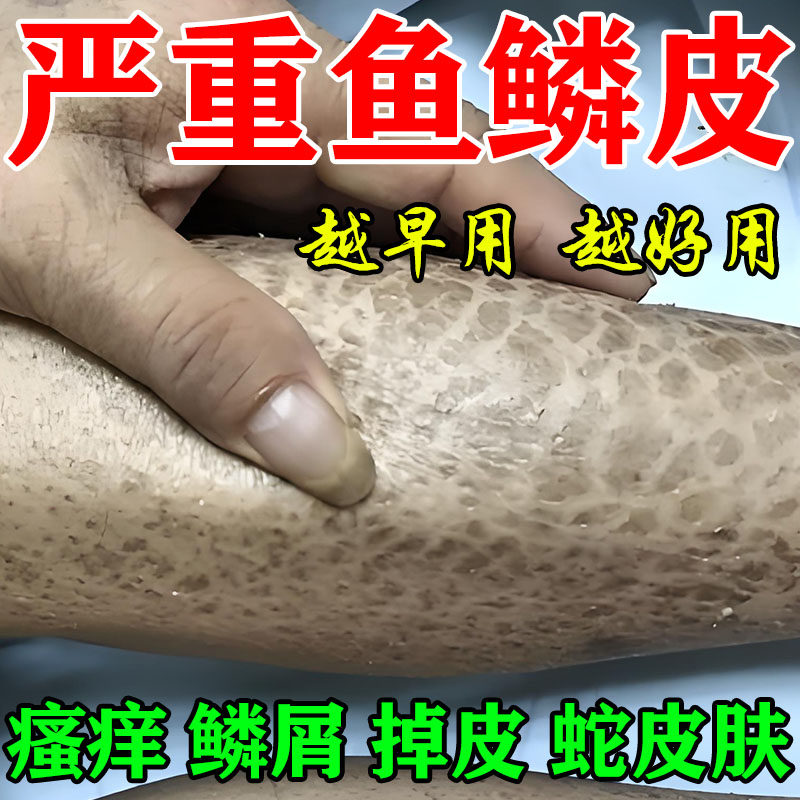 鱼鳞病皮肤霜药膏去蛇皮肤鱼鳞腿部病干燥起皮脱皮毛囊角化角质用