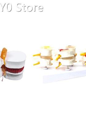 1 Pcs Skeleton Spine Lumbar Disc Herniation Teaching Model &