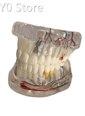 Dental Disease Implant Teeth Model with Restoration Bridge T
