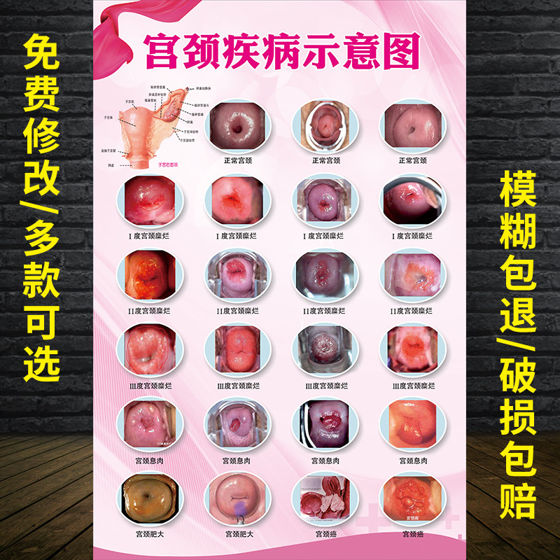 宫颈疾病示意图 女性生殖器系统解剖图女性子宫图片y妇科海报挂