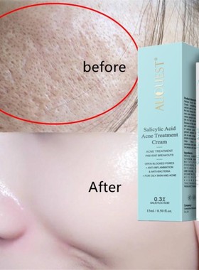 Salicylic Acid Acne Treatment Face Cream Anti-acne Gel Shrin