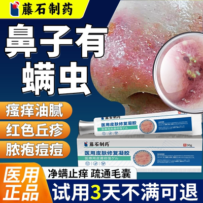 鼻子螨虫痒止痒搭药膏脸部上除螨祛痘黑头粉刺搭酒糟鼻玫瑰痤疮QN