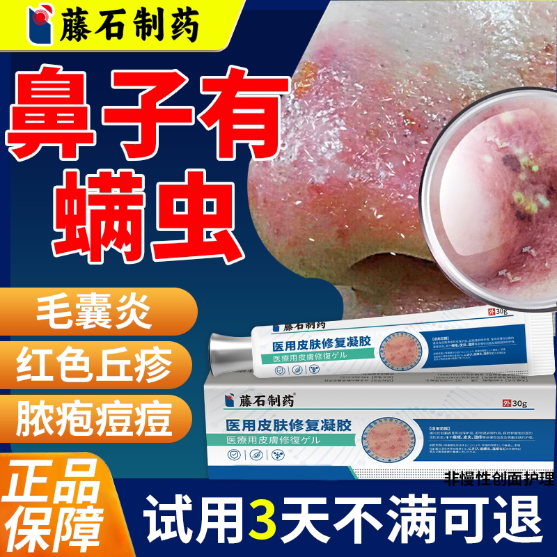 短期鼻子螨虫外面痒毛囊炎长红痘脱皮搭酒糟鼻搭玫瑰痤疮膏QN