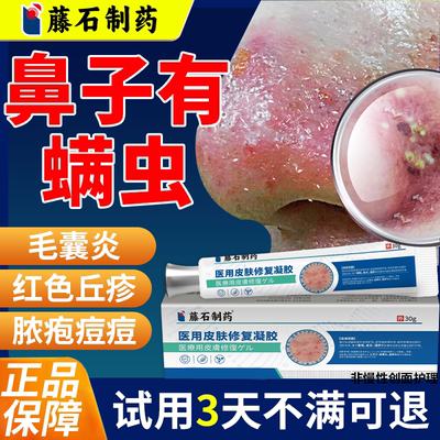 短期鼻子螨虫外面痒毛囊炎长红痘脱皮搭酒糟鼻搭玫瑰痤疮膏QN