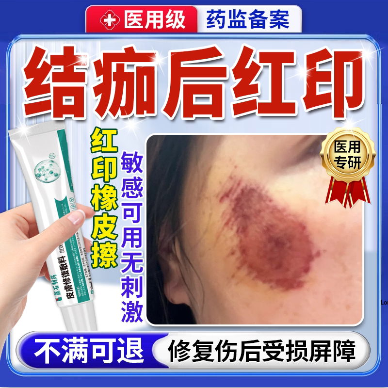 结痂后去红印黑印儿童擦伤摔伤掉痂后除疤痕修复点痣后退红淡印QN图片