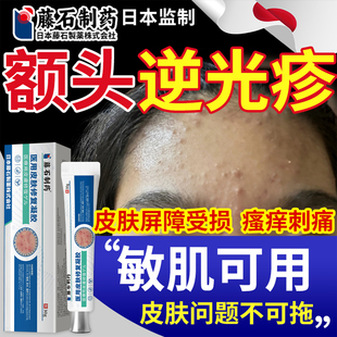 额头上起小疙瘩逆光疹儿童脸部闭口粉刺有小颗粒屏障受损修复YF