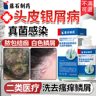 头藓牛皮癣银屑病专用洗发水脂溢性头皮炎真菌感染红斑瘙痒鳞屑JQ