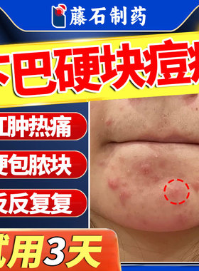 下巴反复长痘痤疮硬疙瘩膏内调理姨妈硬块痘痘内分泌失调火疖子QN