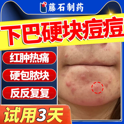 下巴反复长痘痤疮硬疙瘩膏内调理姨妈硬块痘痘内分泌失调火疖子QN