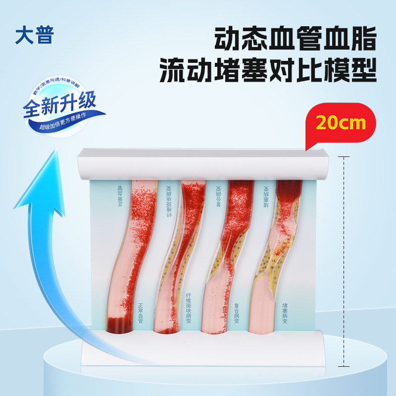 仿真动态血管血脂流动模型血糖浓稠度病变对比斑块血栓加大版教具