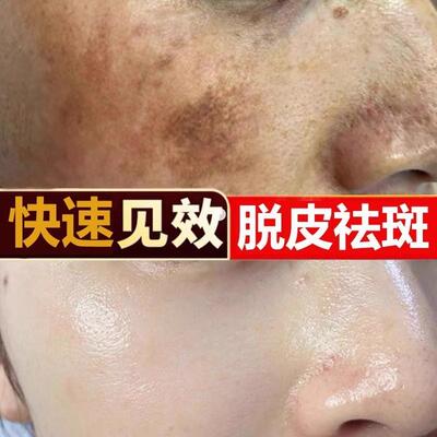 脱皮柔迪美白祛斑霜官方正品旗舰店黄褐斑雀老年斑强力去除黑色素