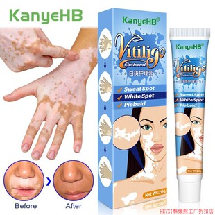20g Herbal Extract Vitiligo Ointment Remove Ringworm White S