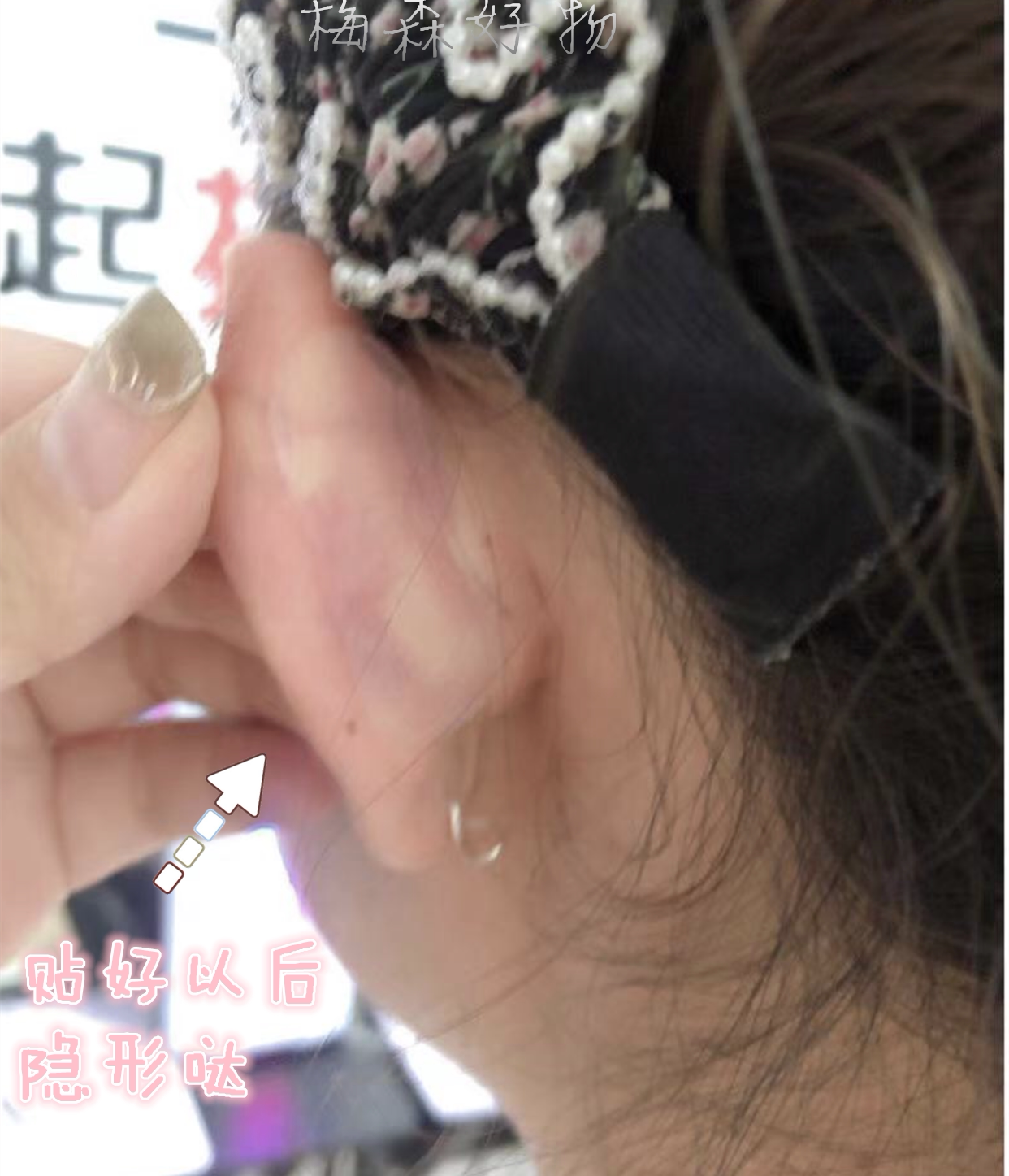 贴面耳神器矫正器改善贴面耳贴面耳撑秒变招风耳神器精灵耳神器贴