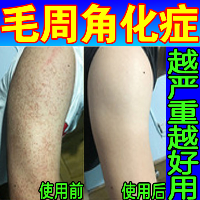 毛周角化症药膏毛囊红斑黑变病脸部干燥起皮去除鸡皮肤疙瘩沐浴露