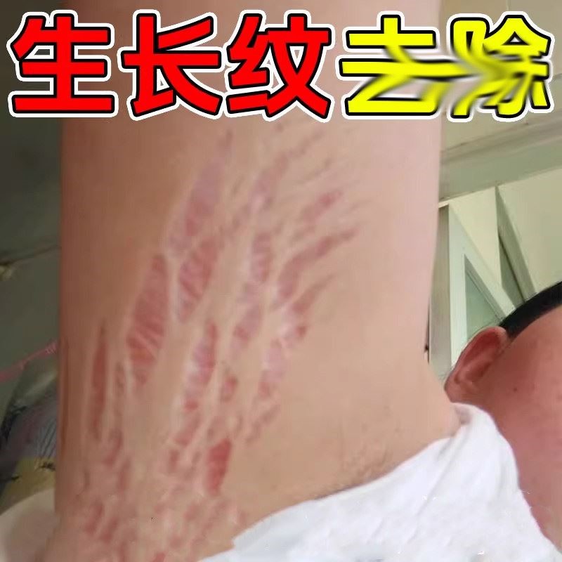 去肥胖纹修复霜生长纹消除大腿学妊娠纹护理