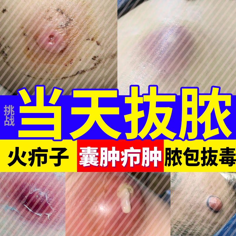 疖肿拔毒膏皮脂腺囊肿火疖子脂肪瘤去除神器断拔毒顽痒清药膏泰国