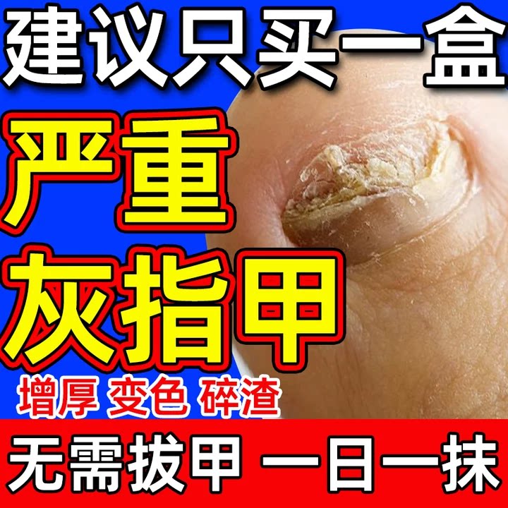 阿莫洛芬去灰指甲真菌甲沟炎治脚趾上空厚甲罗癣感染中药水抑菌液
