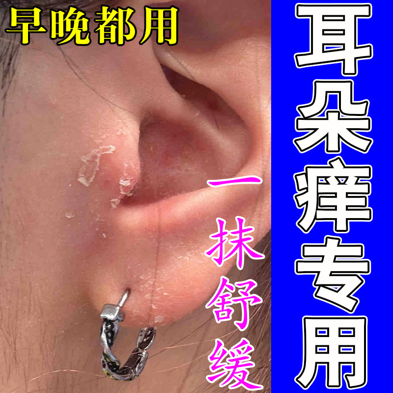 冶外耳道真菌性皮屑干燥痒起皮结痂耳道干屑粗糙脱皮掉屑软膏
