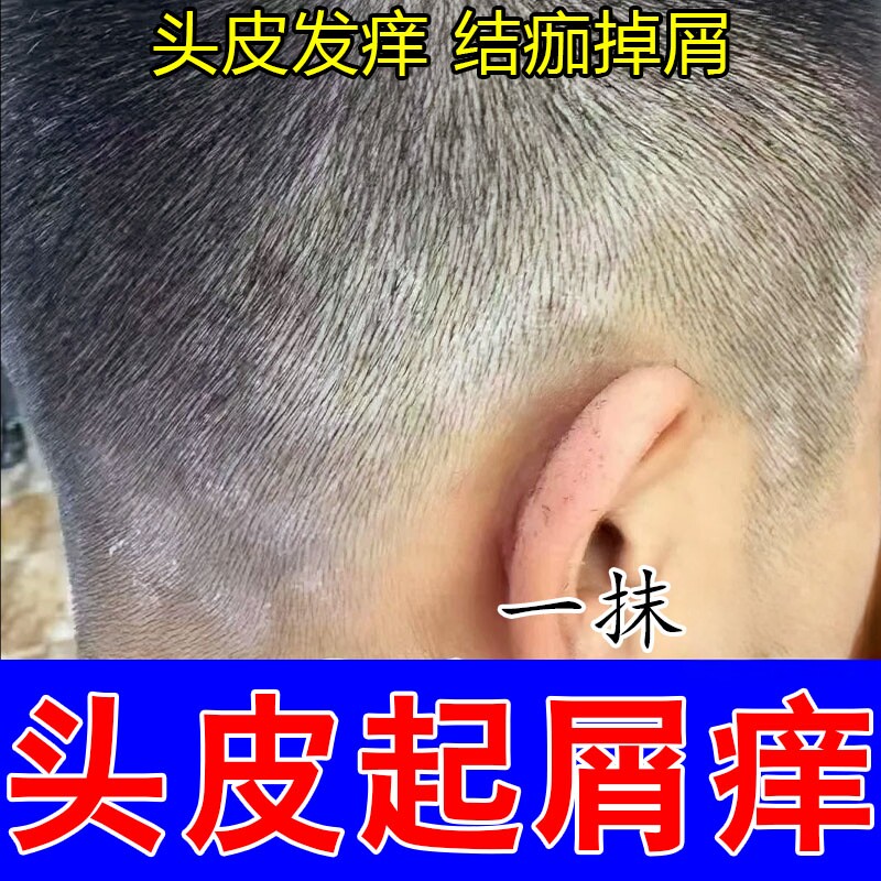 头皮白斑起大片白屑脱屑结痂斑块干痒不适红肿结痂粗糙植物舒缓膏