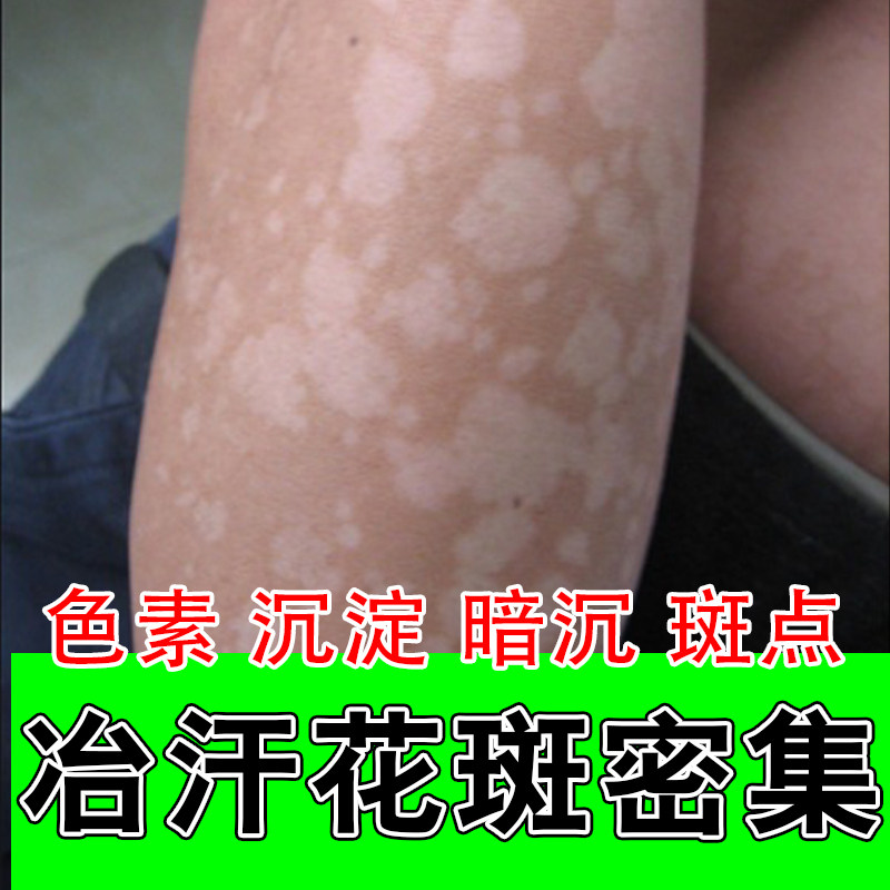 汗斑花斑专用胳膊长片状黄深斑点皮肤消毒护理（消）