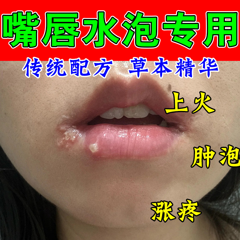 唇周起泡干裂起皮舒缓上火起小泡改善嘴角泛红粗糙温和修护唇膏