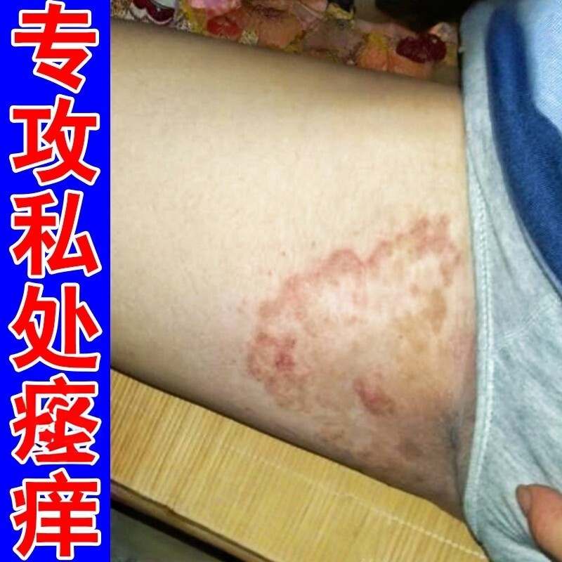 大腿内侧皮痒股/痒痒去长红疙瘩起干皮红斑湿热软膏