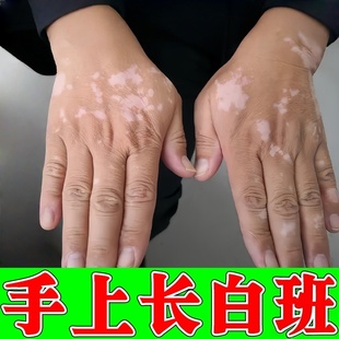 白班膏外用黑色素生长专用快速消手上长白斑补骨脂酊外用软膏