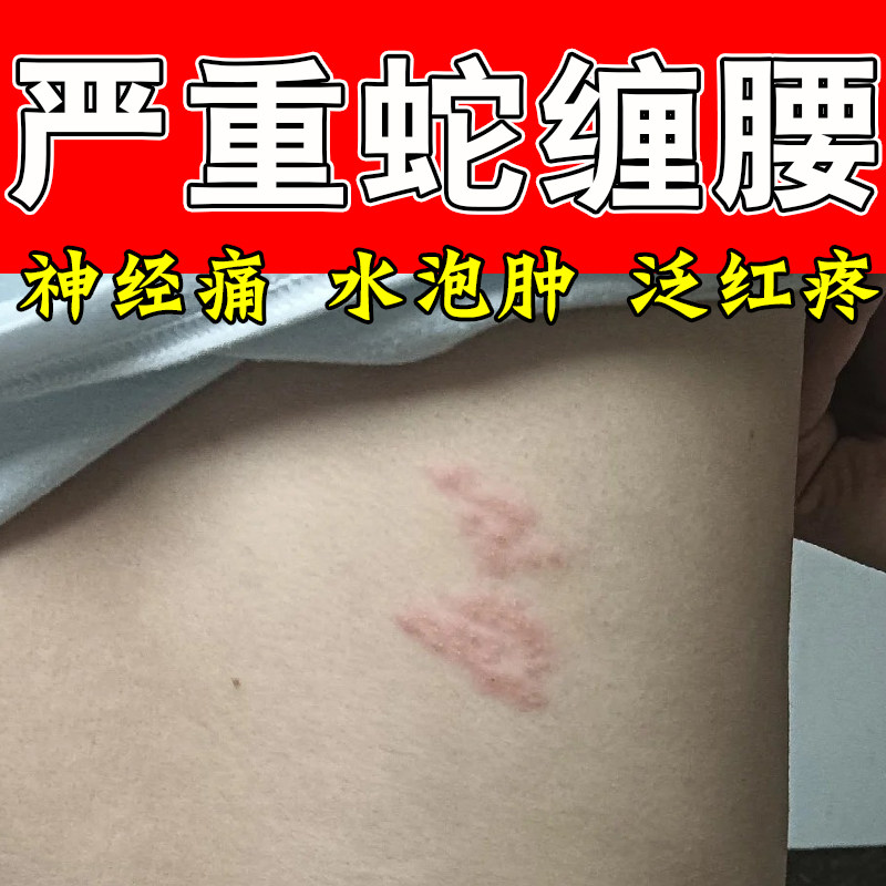 冶身上蛇缠带状红水泡密集缠腰腹水泡红肿刺痒灼热泛红修护膏