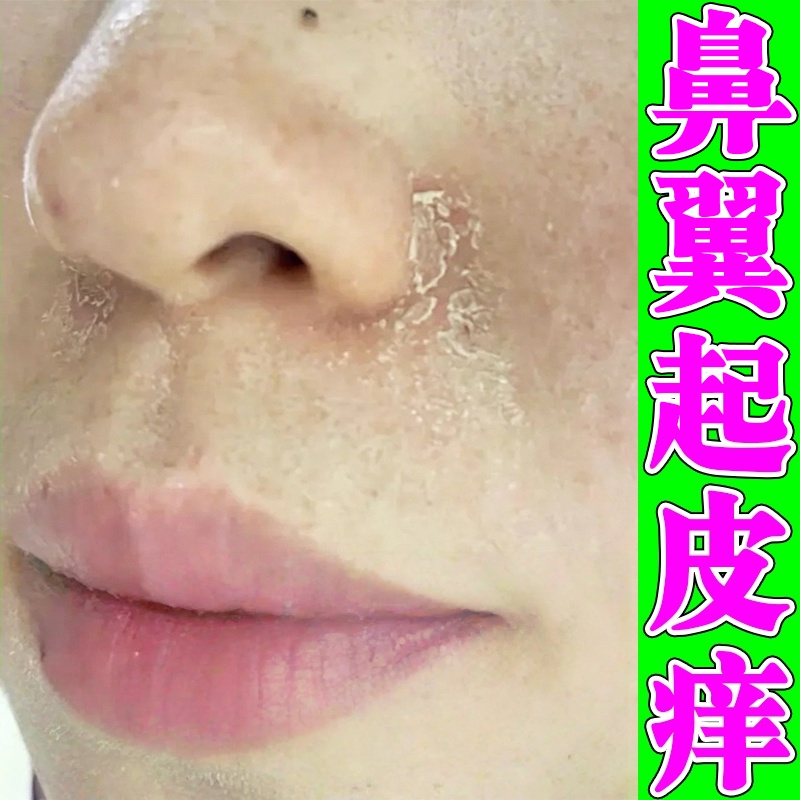 鼻翼两侧发红油腻脱皮鼻子泛红起皮掉皮痒酒糟鼻治红鼻头膏