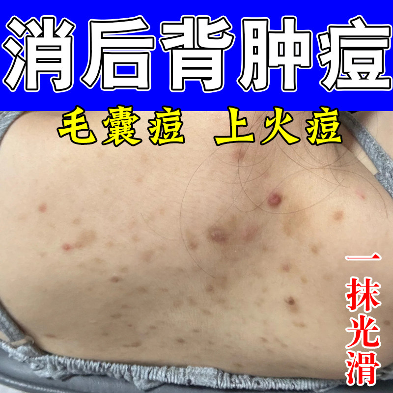 后背马拉色菌毛囊背上长痘皮肤毛囊不适粗糙痒真菌疙瘩修护软膏