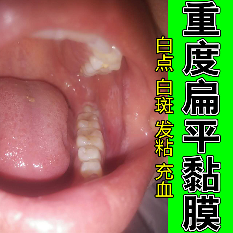 冶嘴巴内壁纤维化白斑口腔黏膜组织口腔黏膜顽固口腔舒缓喷剂