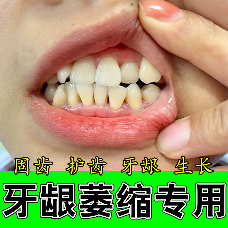 牙齿牙龈缩小牙不稳牙龈退缩泛红牙龈触碰渗血专用牙周修护喷剂