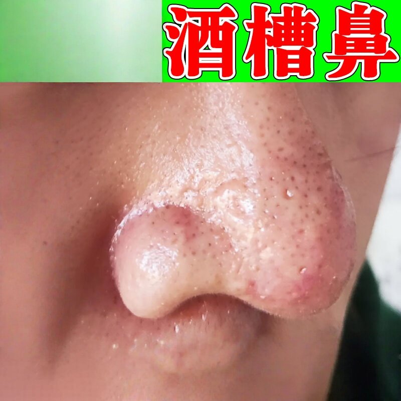 酒糟鼻专用膏治玫瑰痤疮毛孔草莓鼻修复粗大鼻头红肿除螨虫软膏