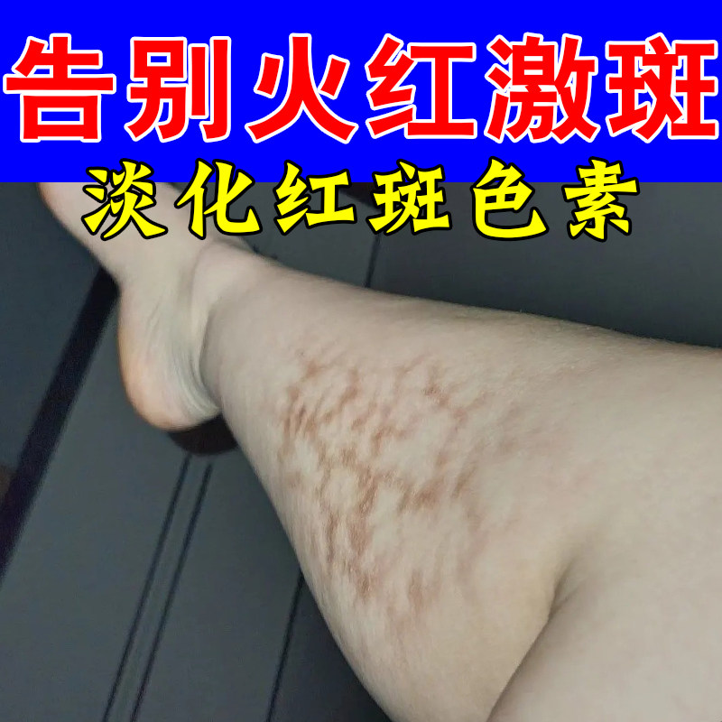 冶火激红斑修护烤火低温烫损腿部水疱网状斑皮下红斑纹路褪修复膏