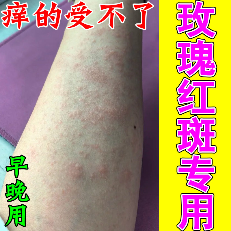 玫瑰红斑皮肤痒过敏红斑起皮干燥起皮红点粗糙痒涂抹修护软膏