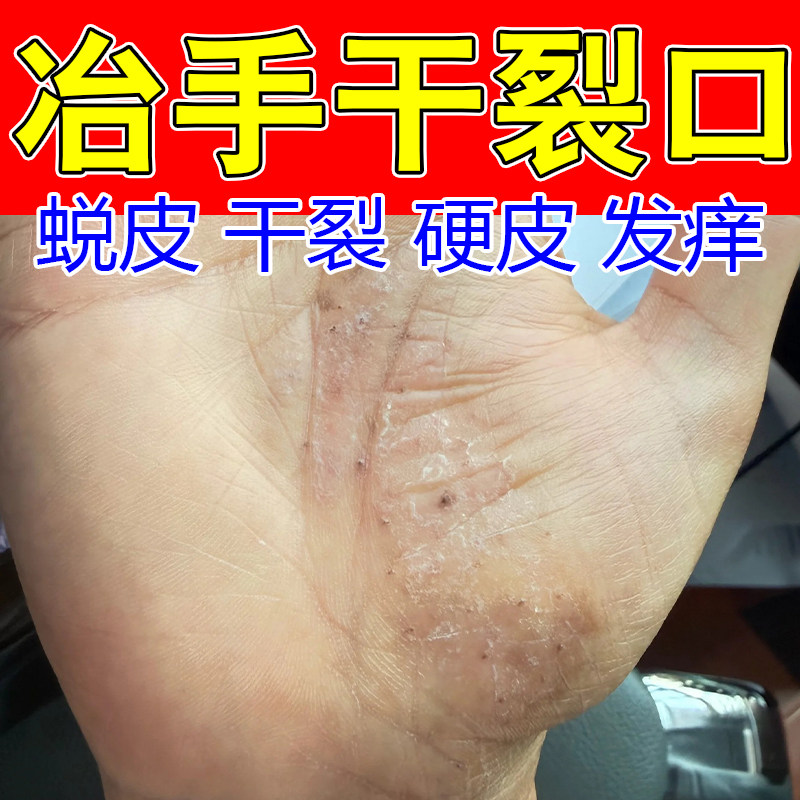 角化型手燥粗糙手干燥起皮干裂发痒粗糙角质化增厚起硬皮草本软膏