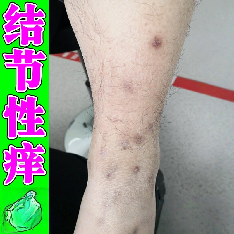 结性痒诊软膏治小腿脚背顽固红硬疙瘩皮肤湿止诊痒痒软膏