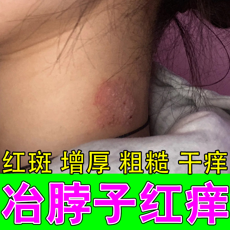 脖子后面发痒长红斑刺挠颈部上起红疙瘩红点粗糙神经性修复膏