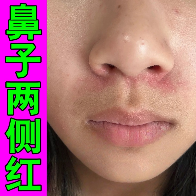 鼻子两侧发红脱皮鼻翼两边干燥起皮掉皮鳞屑长痘痘红血丝过敏修复