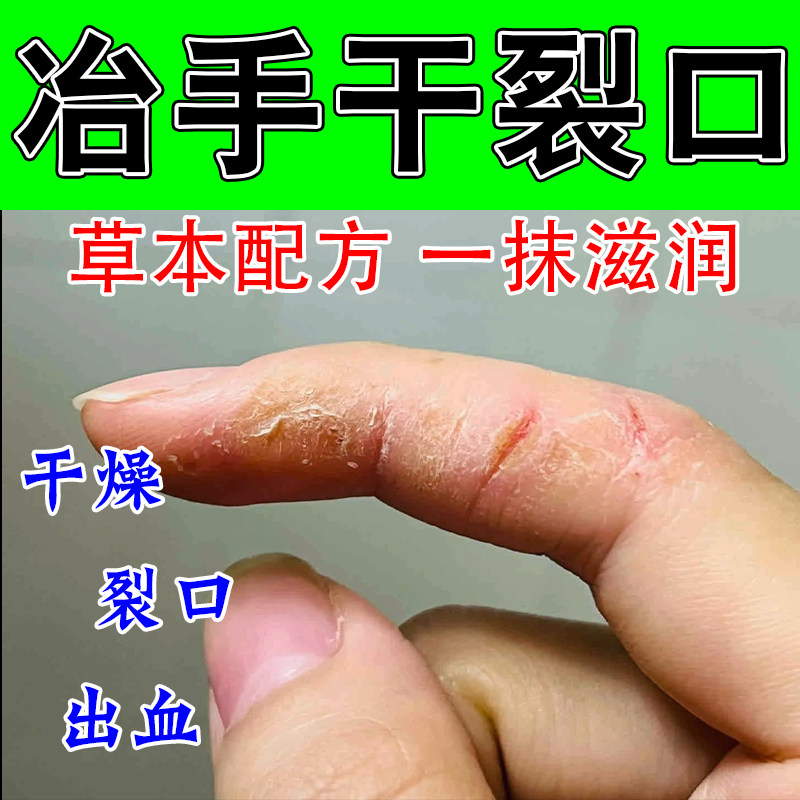 手干裂手指裂口干裂粗糙手指头开裂口疼脱皮真菌粗糙修护植物膏