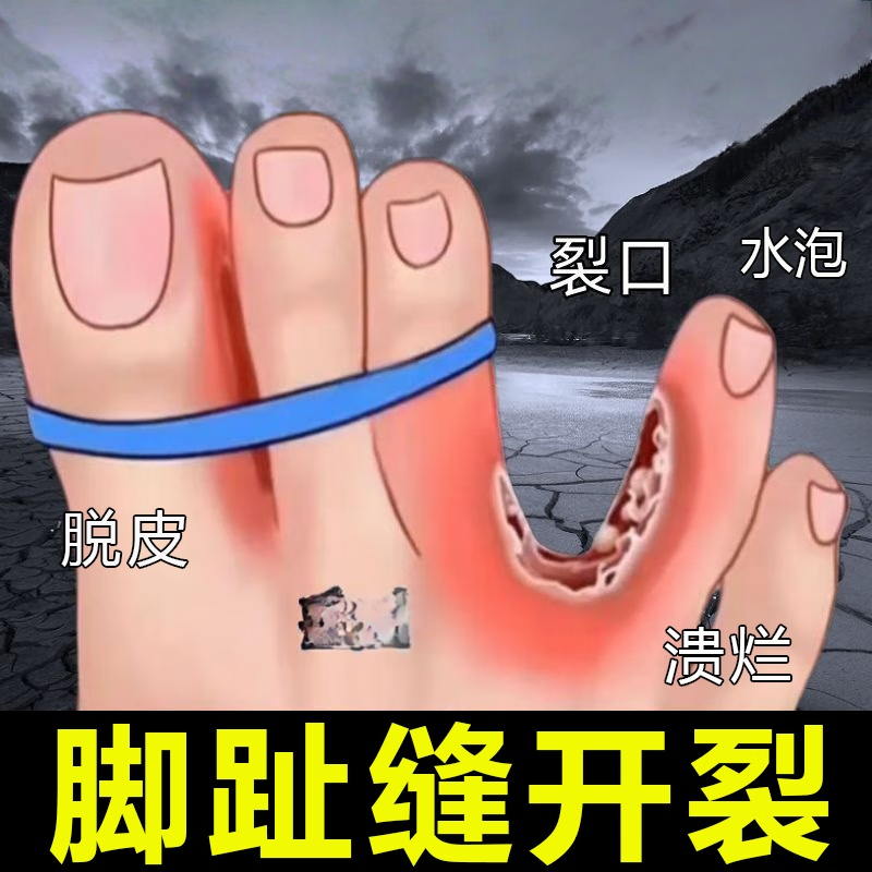 脚趾缝烂痒脱皮开裂烂脚治脚指间分离发白糜烂脚臭出汗专用膏